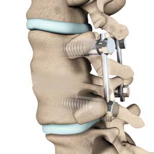 Posterior Fusion